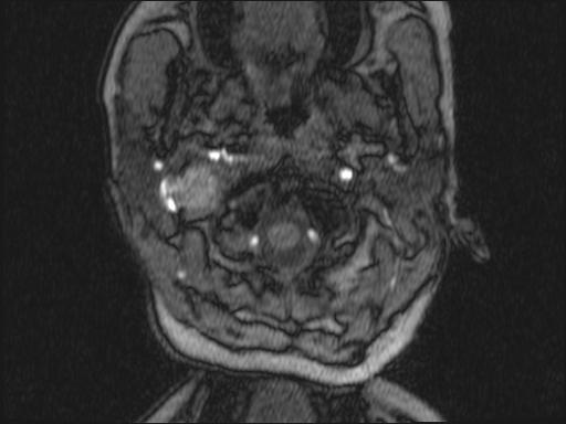 Bilateral carotid body tumors and right glomus jugulare tumor (Radiopaedia 20024-20060 Axial MRA 294).jpg