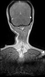 File:Bilateral carotid body tumors and right glomus jugulare tumor (Radiopaedia 20024-20060 MRA 72).jpg