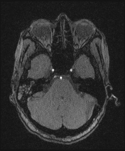 File:Bilateral carotid body tumors and right jugular paraganglioma (Radiopaedia 20024-20060 Axial 160).jpg
