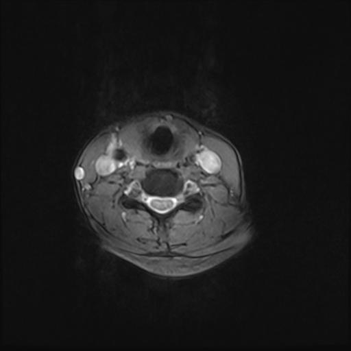 File:Bilateral carotid body tumors and right jugular paraganglioma (Radiopaedia 20024-20060 Axial 86).jpg