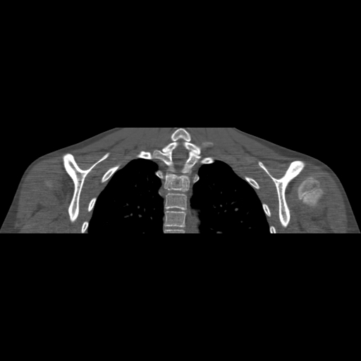 Bilateral chronic posterior shoulder dislocation (Radiopaedia 39213-41452 Coronal bone window 40).jpg
