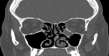 File:Bilateral ectopic infraorbital nerves (Radiopaedia 49006-54084 Coronal 30).png