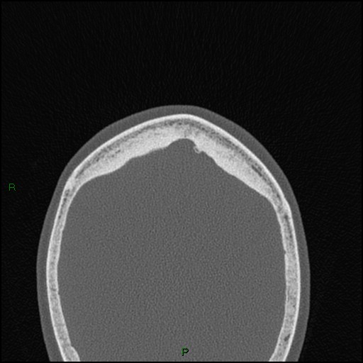 File:Bilateral frontal mucoceles (Radiopaedia 82352-96454 Axial bone window 2).jpg