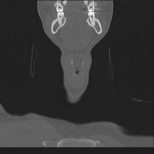 Bilateral locked facets (Radiopaedia 33850-35016 Coronal bone window 9).png