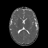 File:Bilateral mesial temporal polymicrogyria (Radiopaedia 76456-88181 Axial ADC 14).jpg
