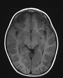 File:Bilateral mesial temporal polymicrogyria (Radiopaedia 76456-88181 Axial T1 11).jpg