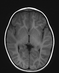 File:Bilateral mesial temporal polymicrogyria (Radiopaedia 76456-88181 Axial T1 12).jpg