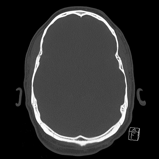 File:Bilateral occipital condyle fracture (type 2) (Radiopaedia 87675-104089 Axial bone window 56).jpg