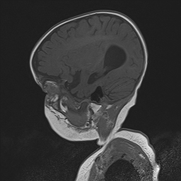 File:Bilateral optic pathway gliomas (Radiopaedia 40013-42514 Sagittal T1 25).jpg