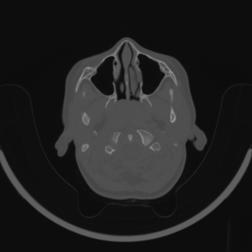 Bilateral otosclerosis (Radiopaedia 57237-64157 C 1).jpg
