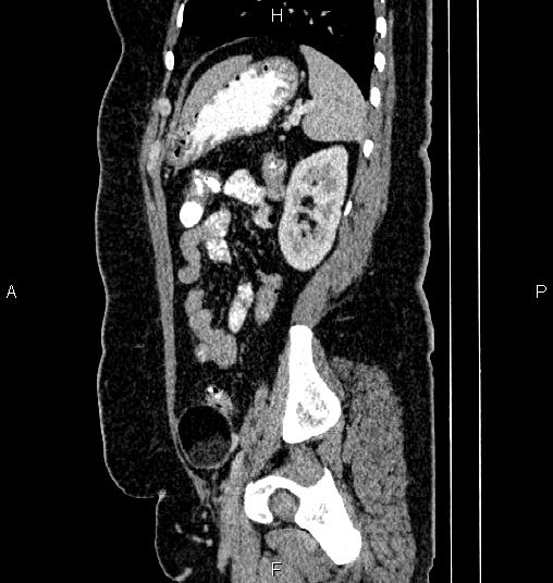 Bilateral ovarian dermoid cysts (Radiopaedia 85785-101603 D 71).jpg