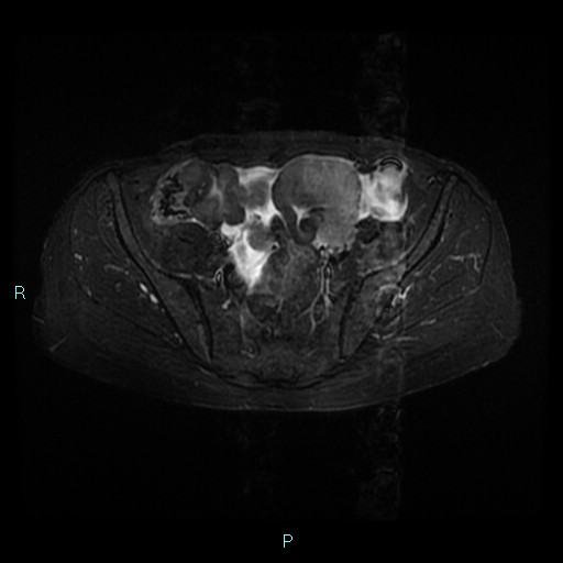 File:Bilateral ovarian fibroma (Radiopaedia 44568-48293 Axial STIR 9).jpg