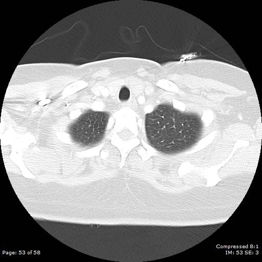 Bilateral pulmonary emboli with Hampton hump sign (Radiopaedia 54070-60246 Axial lung window 53).jpg