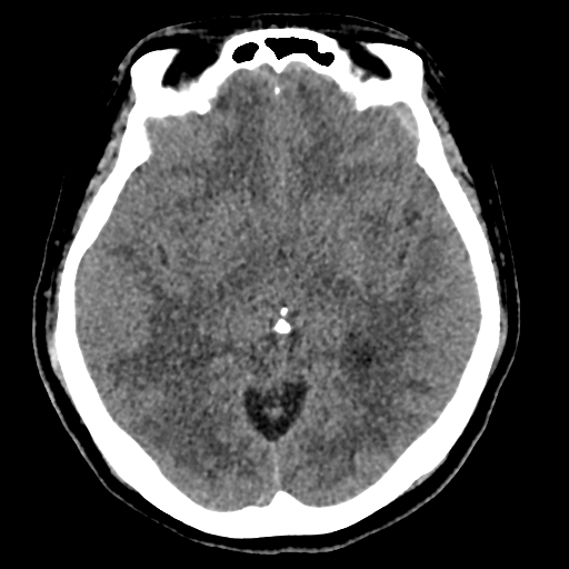 Bilateral subacute subdural hematoma (Radiopaedia 69240-79018 Axial non-contrast 22).jpg