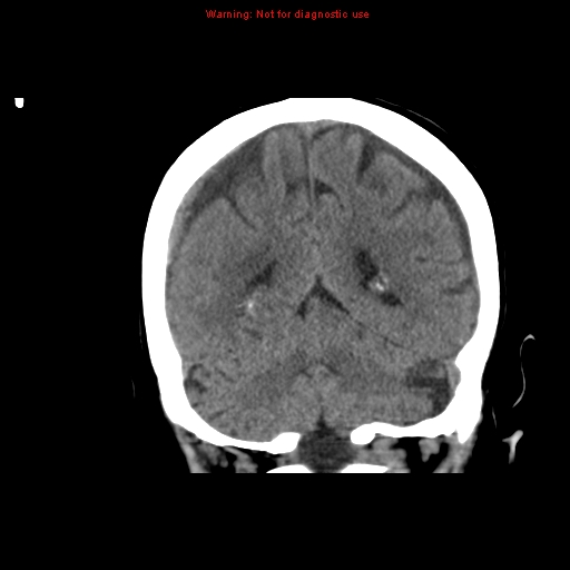 File:Bilateral subdural hemorrhage (Radiopaedia 8819-9620 Coronal non-contrast 15).jpg