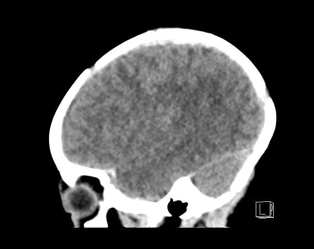 File:Bilateral subdural hemorrhage and parietal skull fracture (Radiopaedia 26058-26192 C 18).png