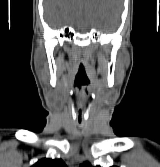 Bilateral submandibular sialolithiasis with sialadenitis (Radiopaedia 70721-80881 Coronal non-contrast 57).jpg