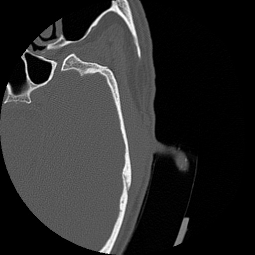 Bilateral temporal bone fractures (Radiopaedia 29482-29970 D 132).jpg