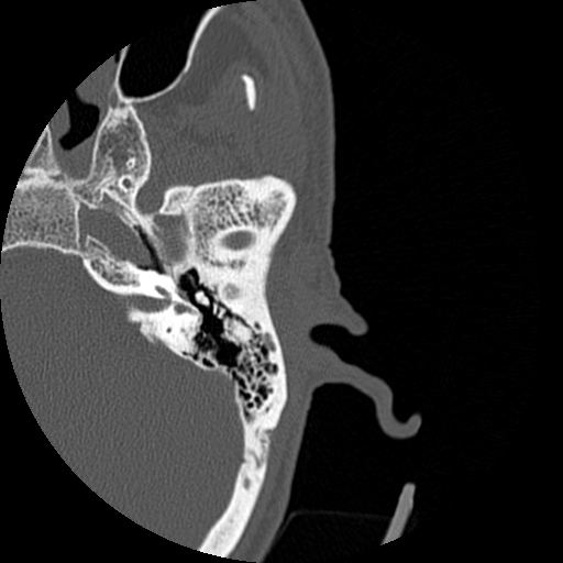 Bilateral temporal bone fractures (Radiopaedia 29482-29970 D 83).jpg