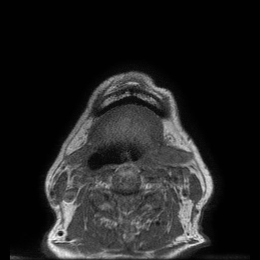 Bisphosphonate-related osteonecrosis of the maxilla (Radiopaedia 51367-57101 Axial T1 1).jpg