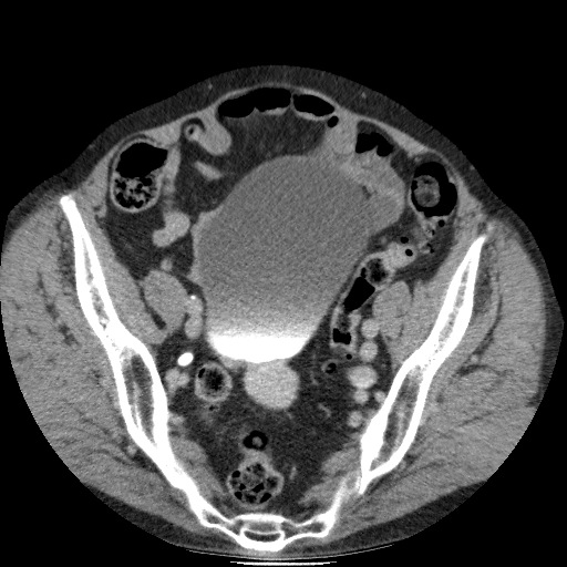 Bladder tumor detected on trauma CT (Radiopaedia 51809-57609 C 110).jpg