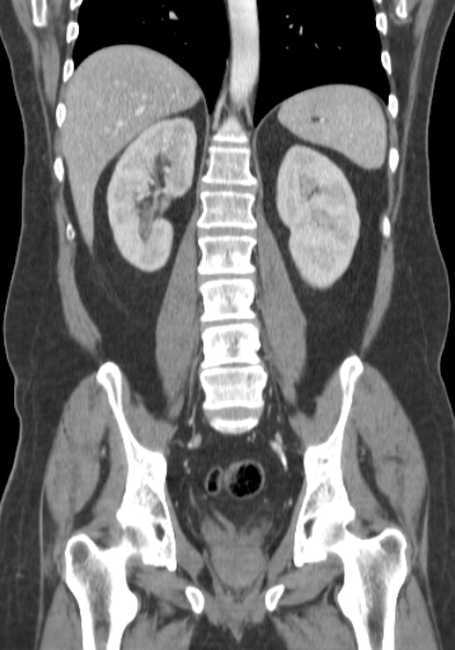 Bleeding duodenal ulcer and adenomyomatosis of gallbladder (Radiopaedia 61834-69861 B 29).jpg