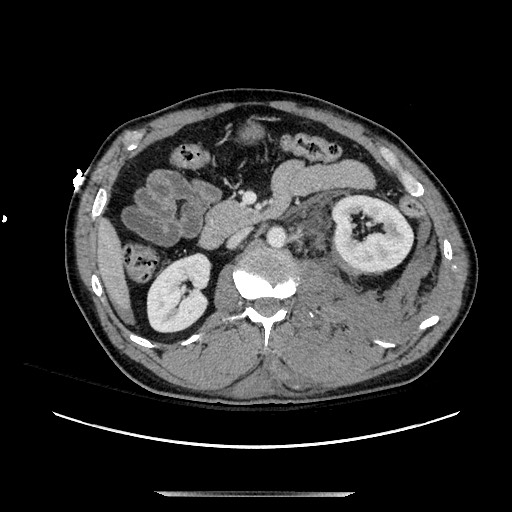 Blunt abdominal trauma with solid organ and musculoskelatal injury with active extravasation (Radiopaedia 68364-77895 A 61).jpg