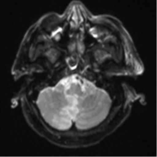 Blunt cerebrovascular injury (Radiopaedia 53682-59745 Axial DWI 7).png