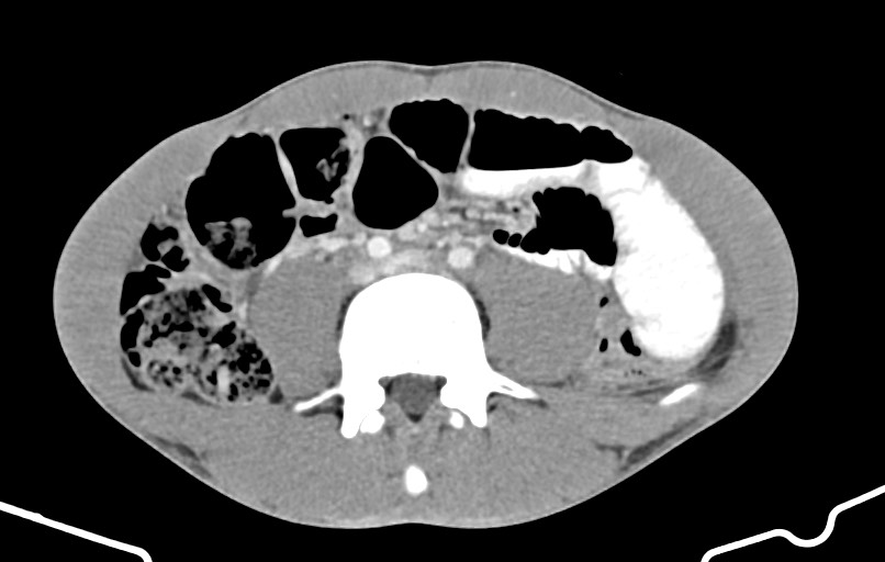 Blunt injury to the small bowel (Radiopaedia 74953-85987 A 114).jpg