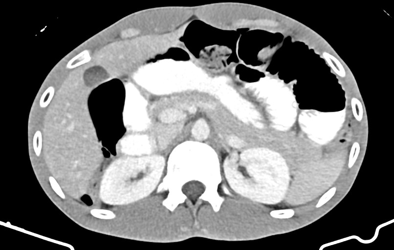 Blunt injury to the small bowel (Radiopaedia 74953-85987 A 42).jpg