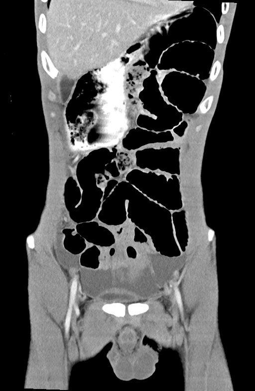 Blunt injury to the small bowel (Radiopaedia 74953-85987 B 25).jpg
