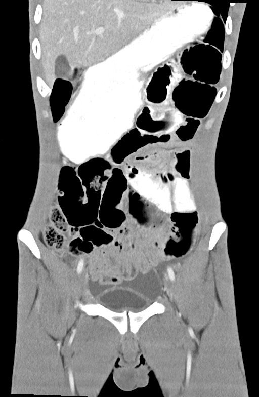 Blunt injury to the small bowel (Radiopaedia 74953-85987 B 31).jpg