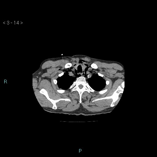 File:Boerhaave syndrome (Radiopaedia 27683-27897 Axial non-contrast 14).jpg