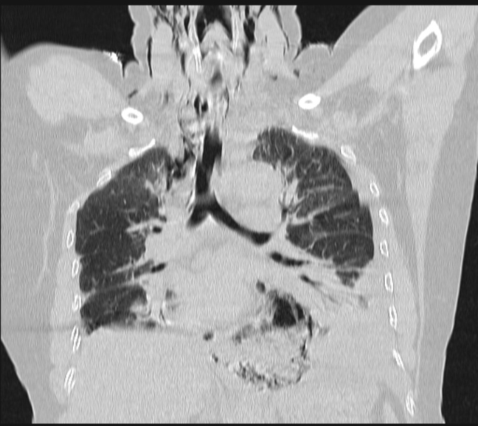 Boerhaave syndrome (Radiopaedia 45644-49799 Coronal lung window 36).jpg