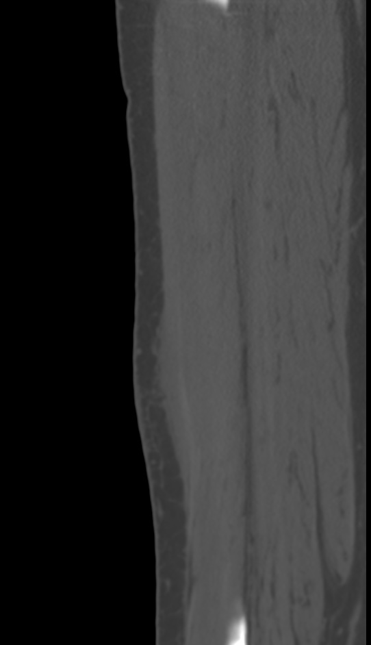 Bone metastasis - tibia (Radiopaedia 57665-64609 Sagittal bone window 126).jpg