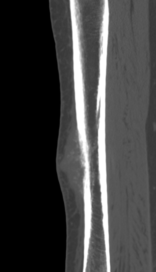 Bone metastasis - tibia (Radiopaedia 57665-64609 Sagittal bone window 71).jpg
