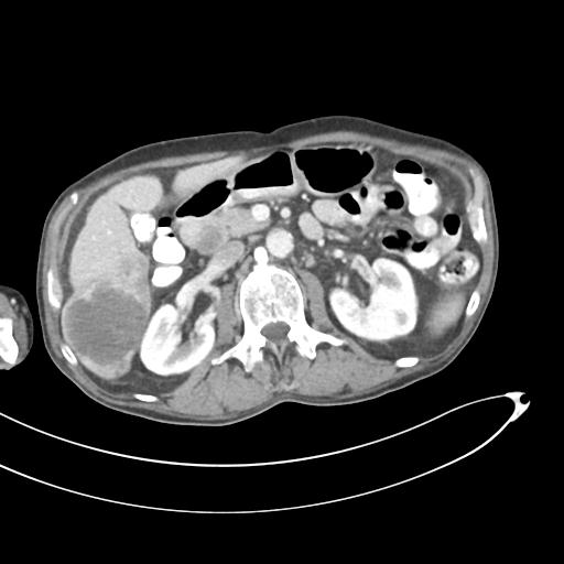 Bone metastasis from squamous cell carcinoma (Radiopaedia 30133-30730 B 28).jpg