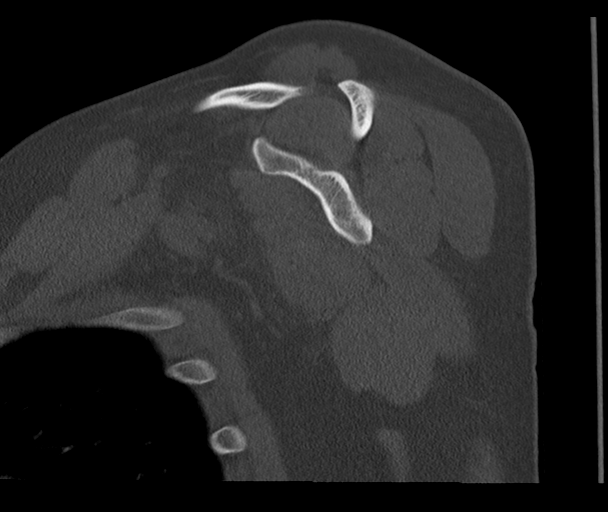 Bony Bankart and Hill-Sachs lesions (Radiopaedia 33622-34727 Sagittal bone window 36).png
