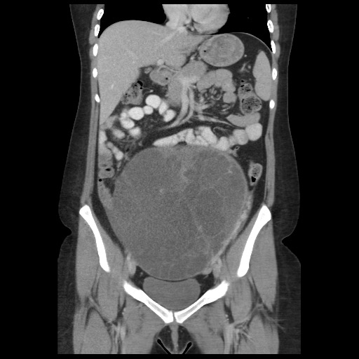 Borderline mucinous tumor (ovary) (Radiopaedia 78228-90808 C 24).jpg