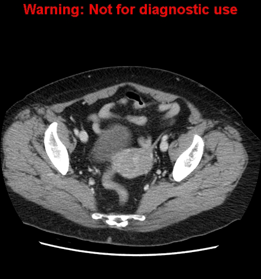 File:Bosniak renal cyst - type II (Radiopaedia 23404-23468 D 62).jpg