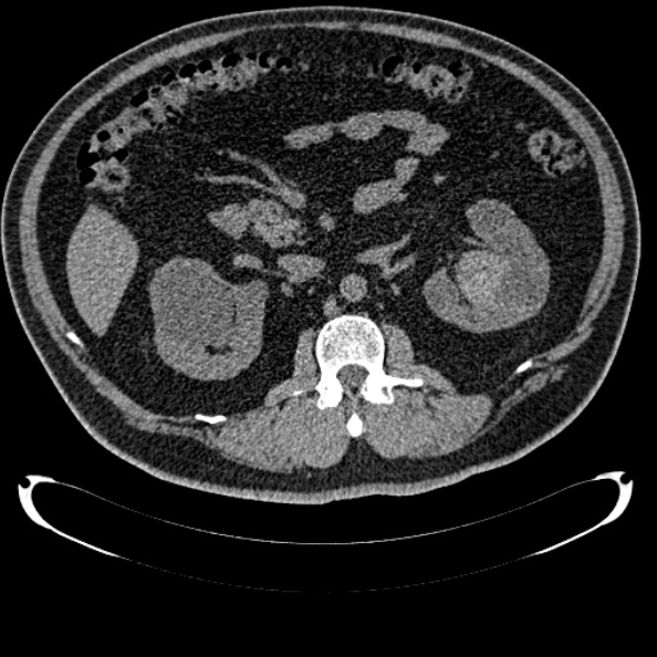 Bosniak renal cyst - type IV (Radiopaedia 24244-24518 Axial non-contrast 142).jpg