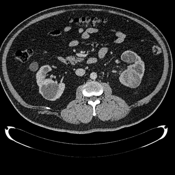 Bosniak renal cyst - type IV (Radiopaedia 24244-24518 C 167).jpg
