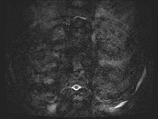 Bouveret syndrome (Radiopaedia 61017-68856 Axial MRCP 2).jpg