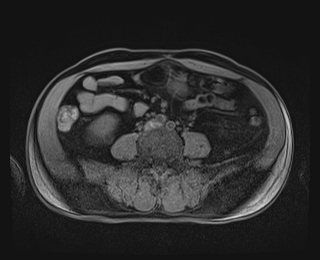 Bouveret syndrome (Radiopaedia 61017-68856 Axial T1 fat sat 62).jpg
