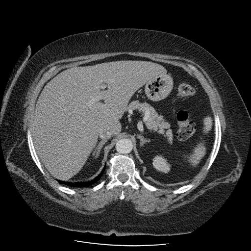 Bovine aortic arch - right internal mammary vein drains into the superior vena cava (Radiopaedia 63296-71875 A 174).jpg