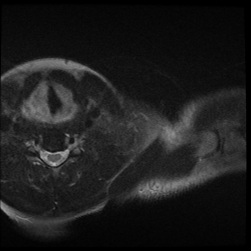 File:Brachial plexus neurofibroma (Radiopaedia 28030-28291 Axial T2 fat sat 16).png