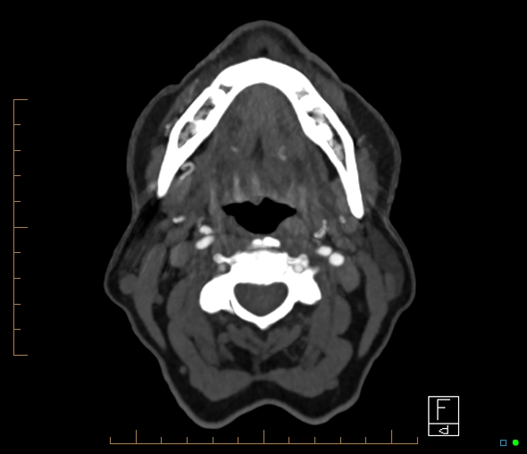 Brachiocephalic trunk stenosis (Radiopaedia 87242-103519 A 84).jpg