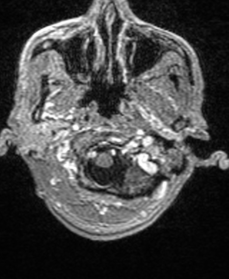 Brain abscess with dual rim sign (Radiopaedia 87566-103938 Axial T1 C+ 21).jpg