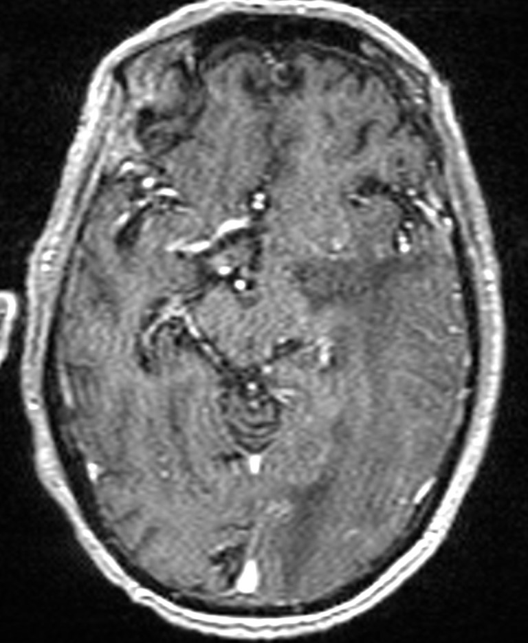 Brain abscess with dual rim sign (Radiopaedia 87566-103938 Axial T1 C+ 74).jpg