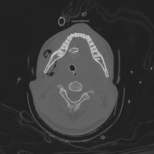 File:Brain contusions, internal carotid artery dissection and base of skull fracture (Radiopaedia 34089-35339 Axial bone window 22).png